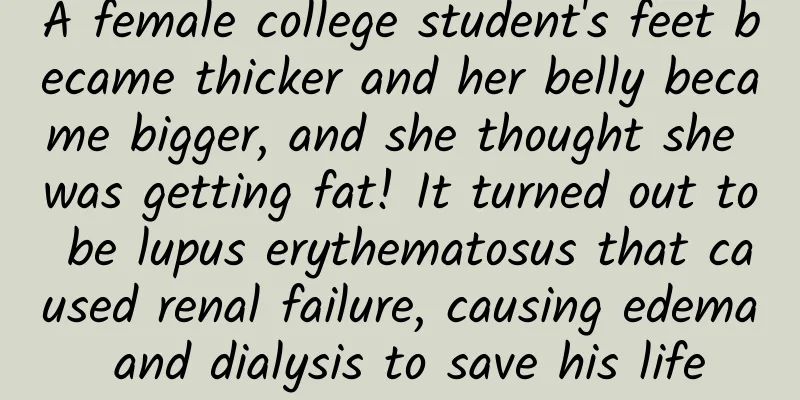 A female college student's feet became thicker and her belly became bigger, and she thought she was getting fat! It turned out to be lupus erythematosus that caused renal failure, causing edema and dialysis to save his life