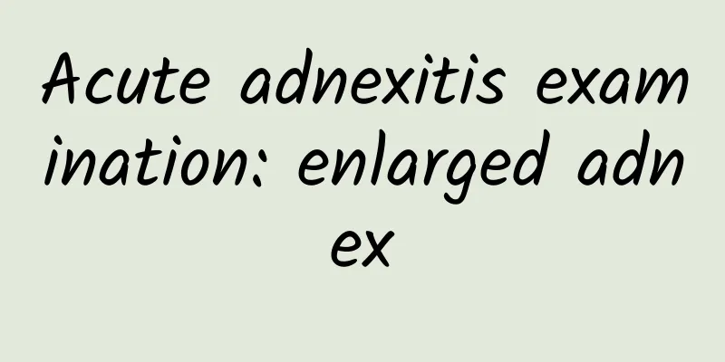 Acute adnexitis examination: enlarged adnex