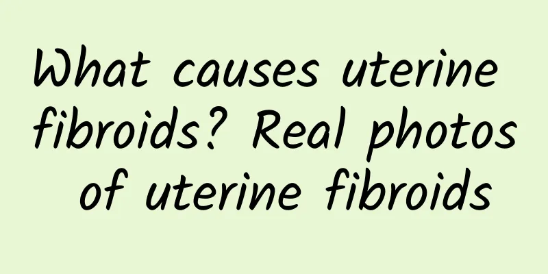 What causes uterine fibroids? Real photos of uterine fibroids