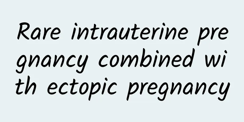 Rare intrauterine pregnancy combined with ectopic pregnancy