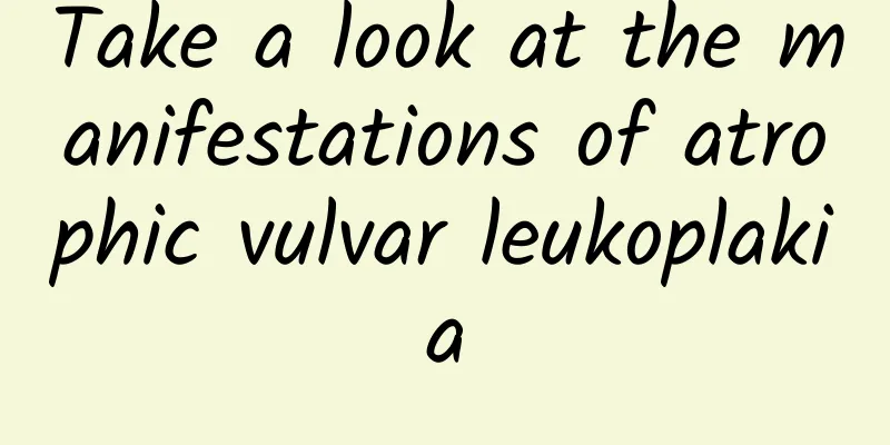 Take a look at the manifestations of atrophic vulvar leukoplakia